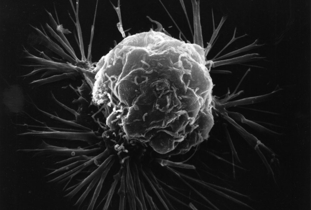 рак молочной железы под микроскопом, фото