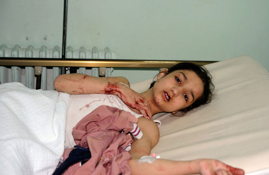Девочка, пострадавшая в результате взрыва, фото, Сирия